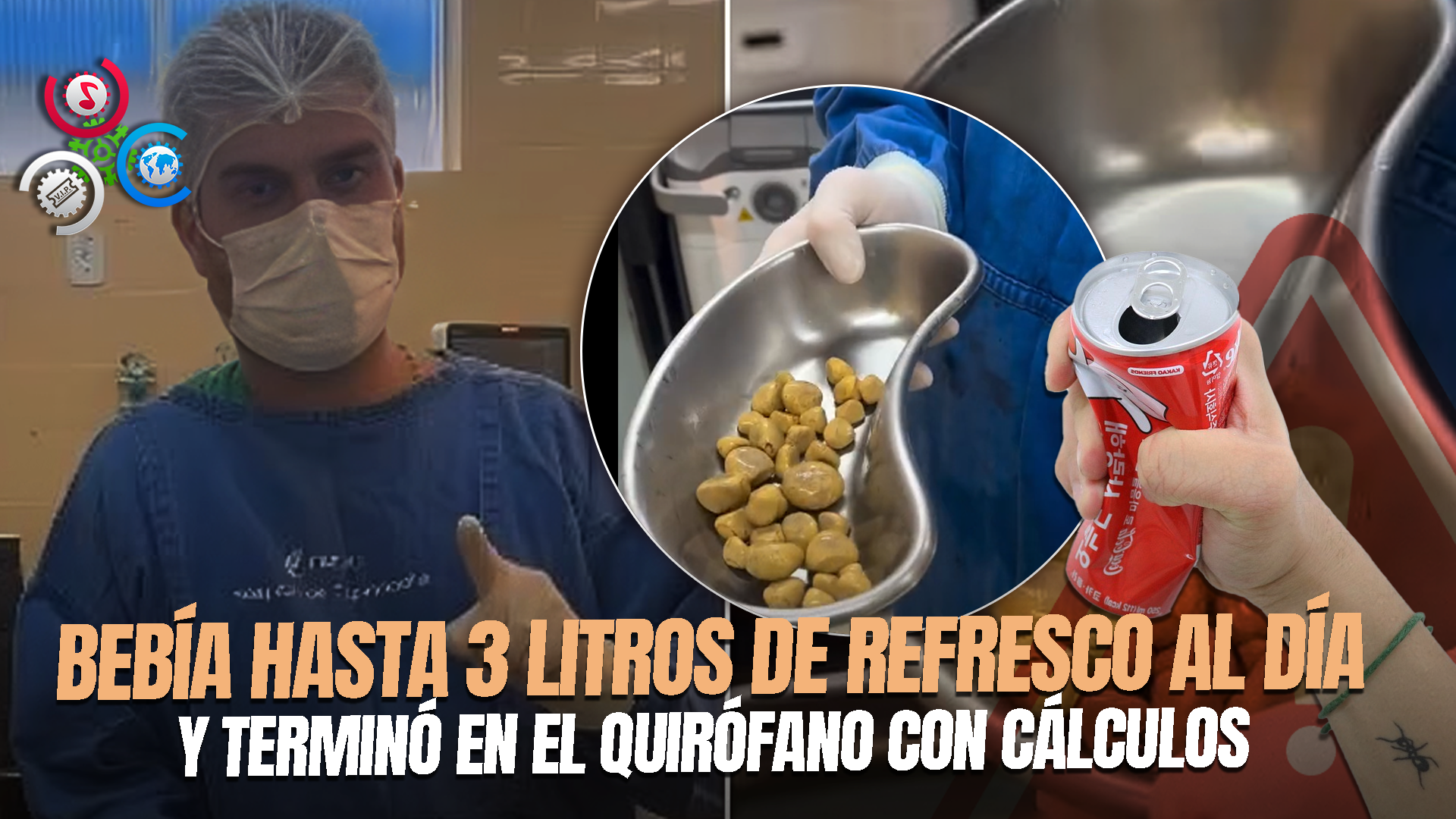Extraen 35 PIEDRAS EN LOS RIÑONES A Un Hombre En Brasil Tras Consumo Excesivo De Coca-Cola