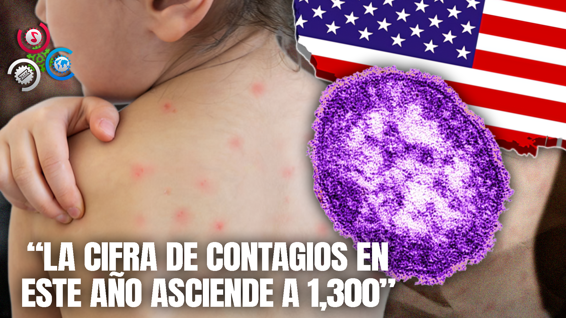 EE.UU. Vive Su Peor Brote De Sarampión En 33 Años, Alertan Autoridades